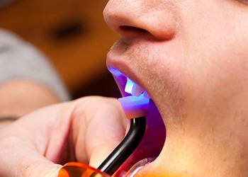 A curing light being used on a patient’s mouth