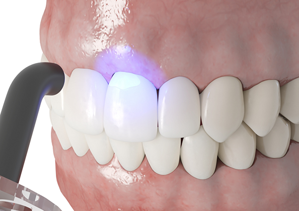 Illustration of an ultraviolet light shining onto teeth
