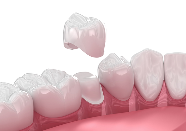 Illustration of a dental crown being placed over a tooth