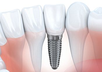 Animation of dental implant supported replacment tooth