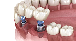 Illustration of two dental implants and a bridge replacing three teeth