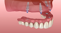 Illustration of four dental implants and a denture replacing an arch of teeth