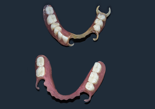 Two partial dentures