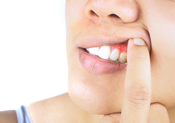 Close up of a person pointing to a red spot in their gums