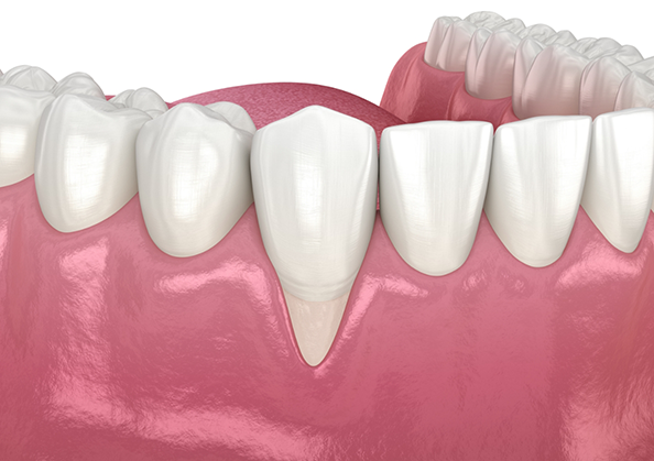 Illustration of a mouth with receding gums
