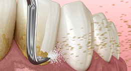 Illustration of dental instruments clearing tartar buildup from the teeth and gums