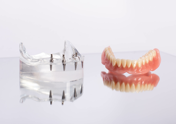 Full denture next to a model of the lower jaw with several dental implants