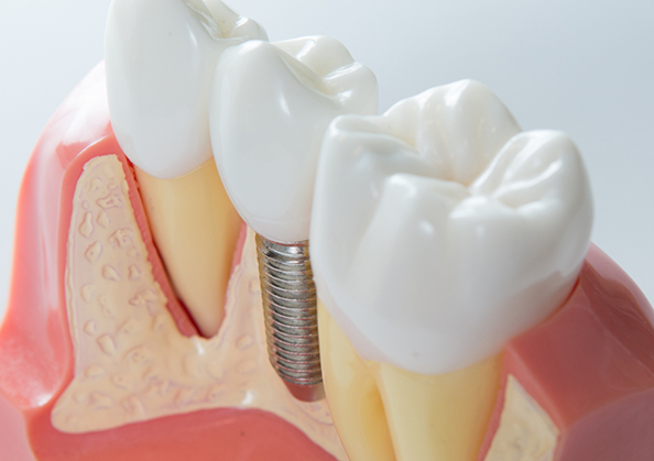 Model of a dental implant between two natural teeth