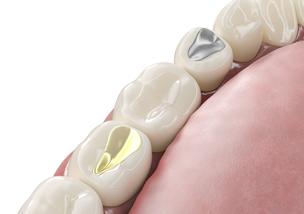 Illustration of a row of teeth with differently colored fillings