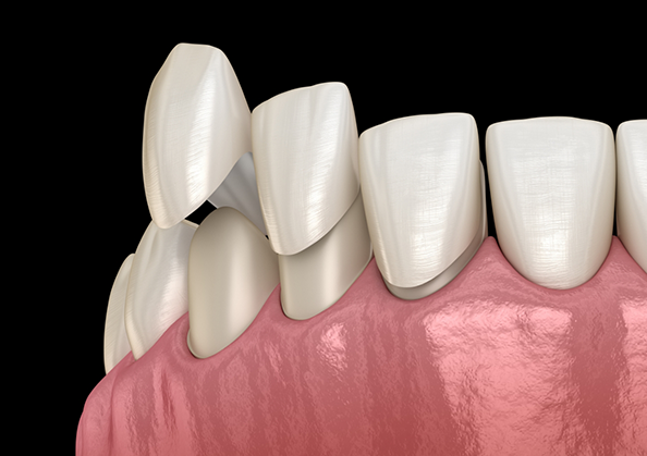 Illustration of veneers being placed over the fronts of teeth