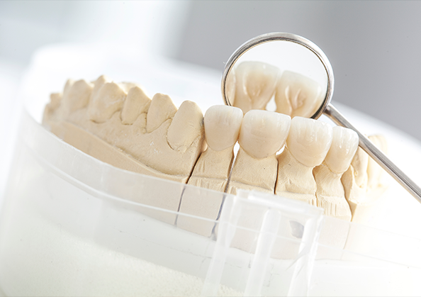 Model of the mouth with dental crowns over several teeth
