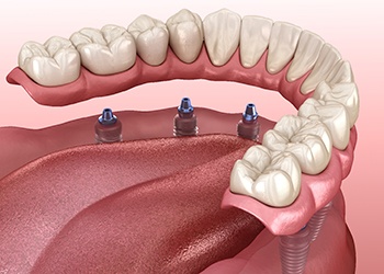 A digital image of an implant-retained denture being secured to the tops of dental implants