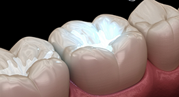 Illustration of a tooth with a white filling