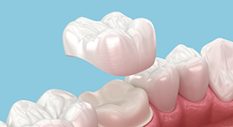 Illustrated dental crown being placed over a tooth