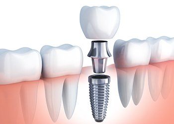 Animation of dental implant supported dental crown